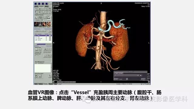 【PPT】胰腺动脉CT增强造影三维后处理与结构化报告书写