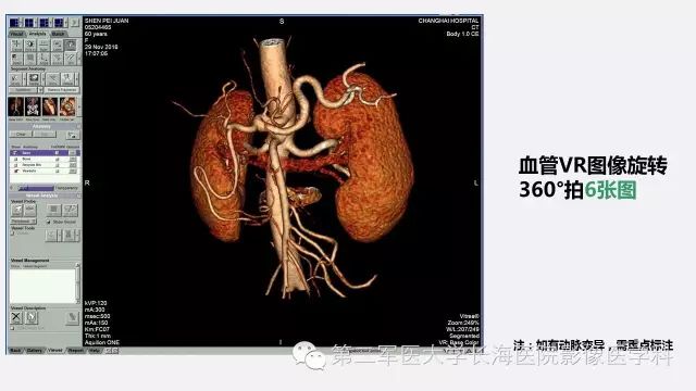 【PPT】胰腺动脉CT增强造影三维后处理与结构化报告书写