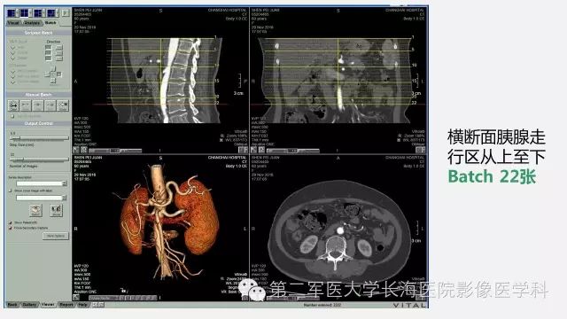 【PPT】胰腺动脉CT增强造影三维后处理与结构化报告书写
