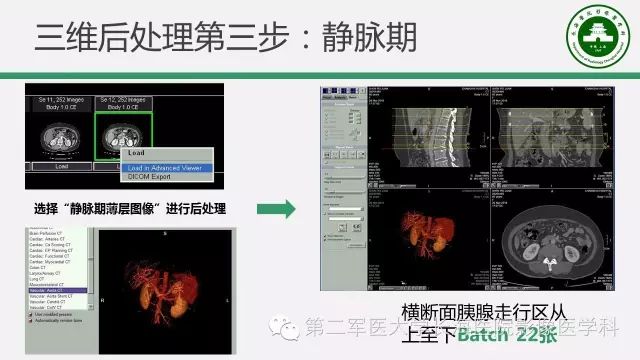 【PPT】胰腺动脉CT增强造影三维后处理与结构化报告书写