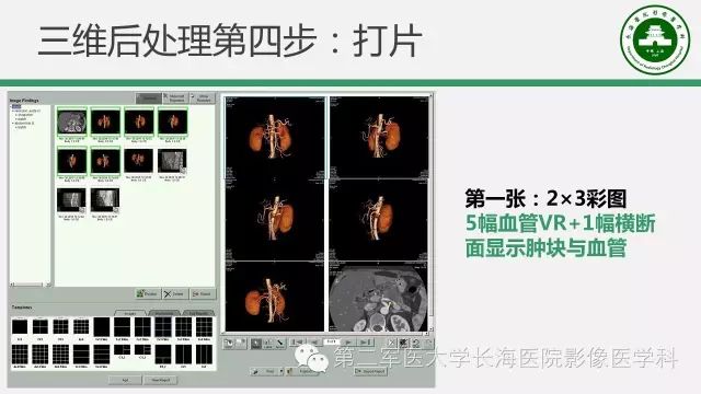 【PPT】胰腺动脉CT增强造影三维后处理与结构化报告书写