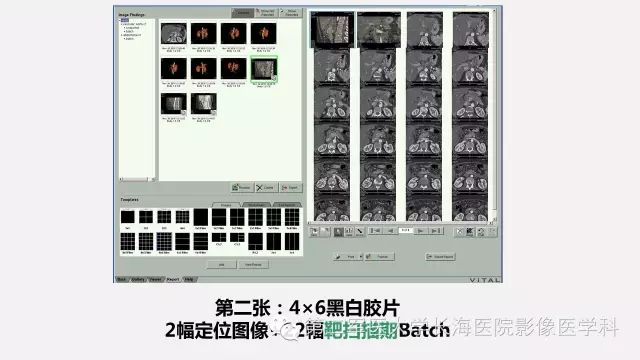 【PPT】胰腺动脉CT增强造影三维后处理与结构化报告书写