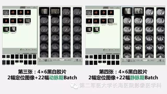 【PPT】胰腺动脉CT增强造影三维后处理与结构化报告书写