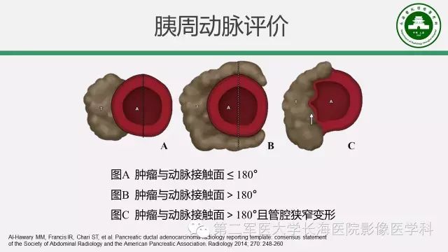 【PPT】胰腺动脉CT增强造影三维后处理与结构化报告书写