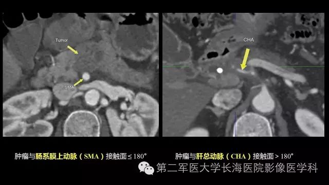 【PPT】胰腺动脉CT增强造影三维后处理与结构化报告书写