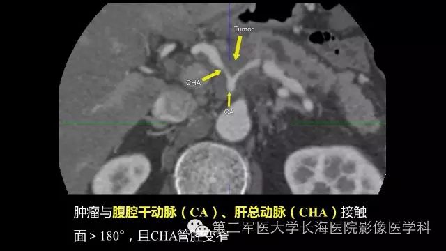 【PPT】胰腺动脉CT增强造影三维后处理与结构化报告书写