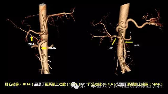 【PPT】胰腺动脉CT增强造影三维后处理与结构化报告书写
