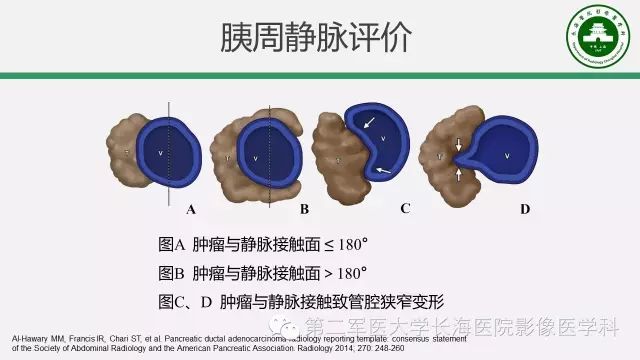 【PPT】胰腺动脉CT增强造影三维后处理与结构化报告书写