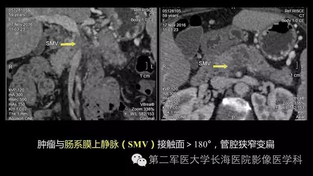 【PPT】胰腺动脉CT增强造影三维后处理与结构化报告书写