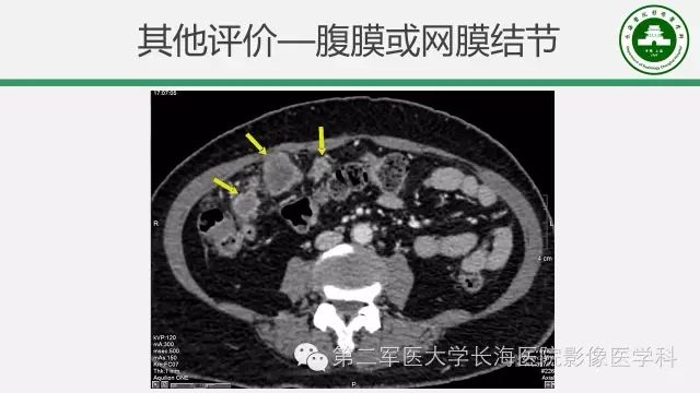【PPT】胰腺动脉CT增强造影三维后处理与结构化报告书写