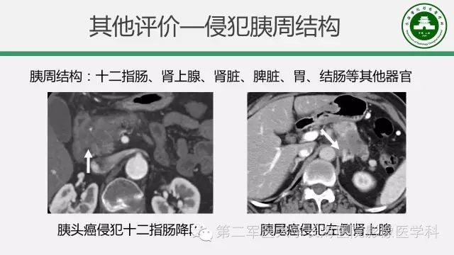 【PPT】胰腺动脉CT增强造影三维后处理与结构化报告书写