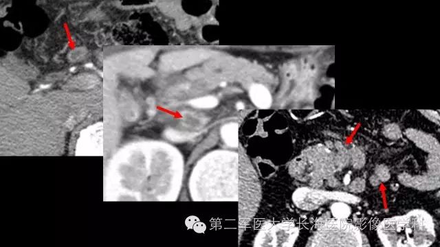 【PPT】胰腺动脉CT增强造影三维后处理与结构化报告书写