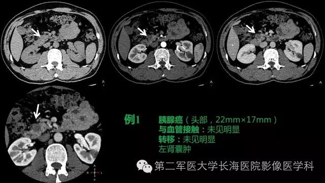 【PPT】胰腺动脉CT增强造影三维后处理与结构化报告书写