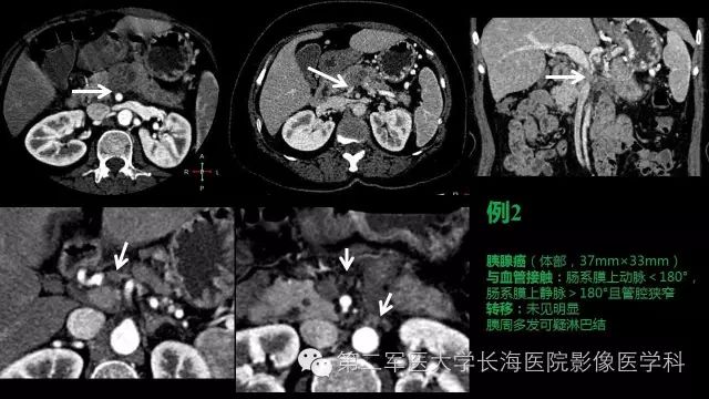 【PPT】胰腺动脉CT增强造影三维后处理与结构化报告书写