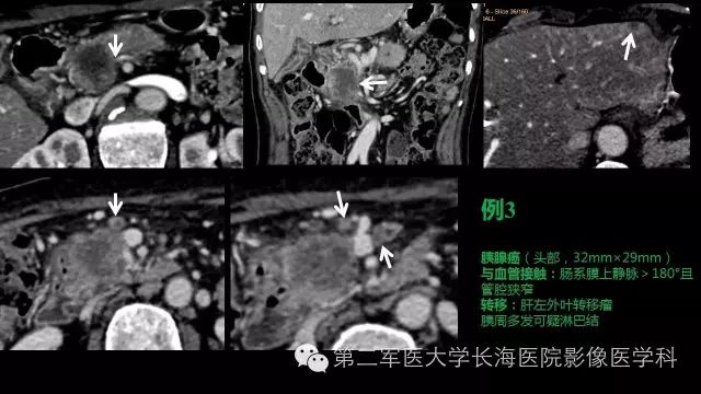 【PPT】胰腺动脉CT增强造影三维后处理与结构化报告书写