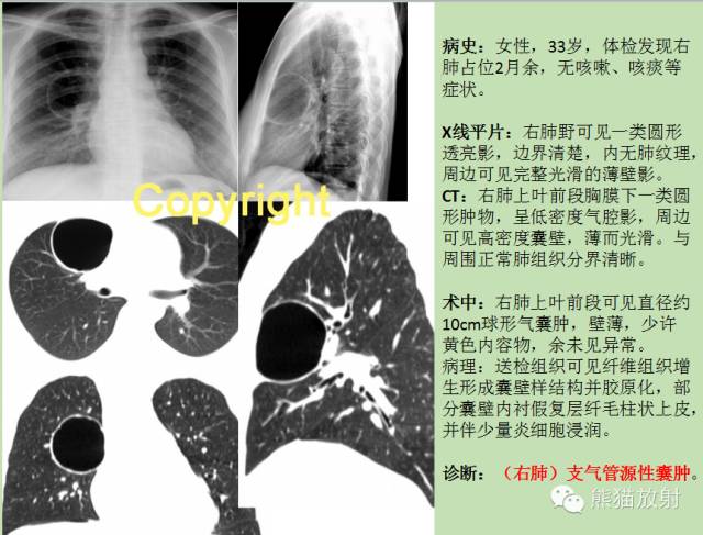 支气管源性囊肿的CT诊断与误诊分析 支气管源性囊肿的CT诊断与误诊分析