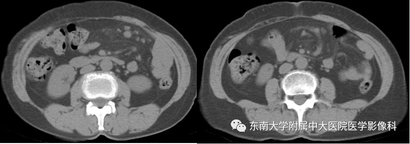 【病例】肠系膜脂膜炎1例CT影像诊断