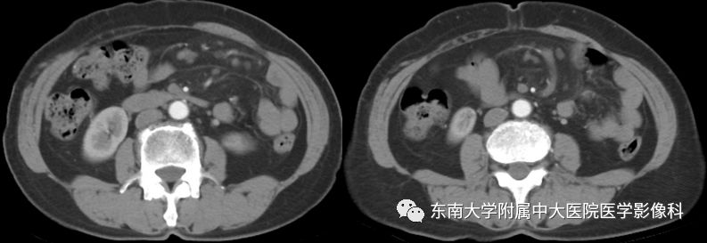 【病例】肠系膜脂膜炎1例CT影像诊断