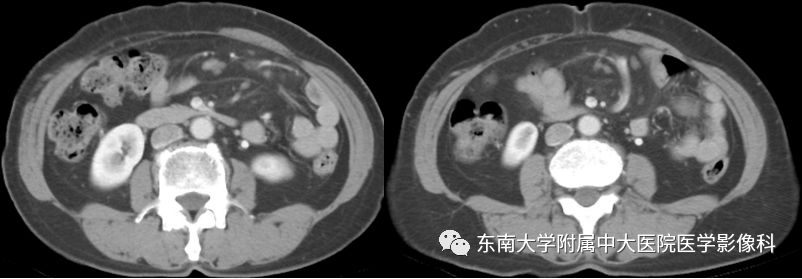 【病例】肠系膜脂膜炎1例CT影像诊断