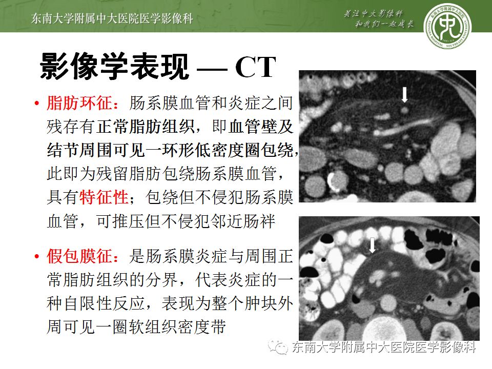 【病例】肠系膜脂膜炎1例CT影像诊断