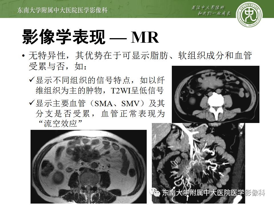 【病例】肠系膜脂膜炎1例CT影像诊断
