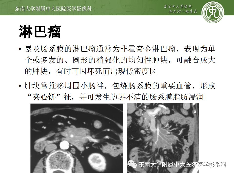 【病例】肠系膜脂膜炎1例CT影像诊断