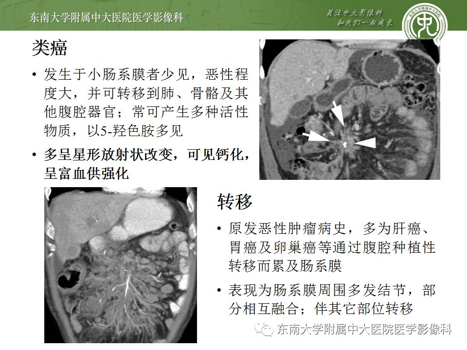 【病例】肠系膜脂膜炎1例CT影像诊断