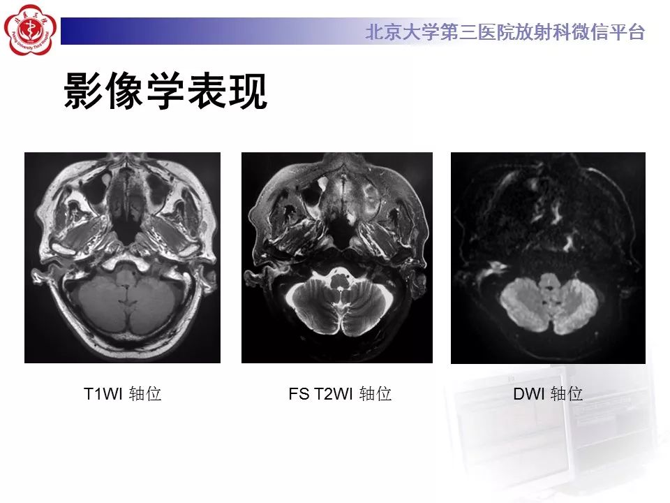 【病例】外耳道鳞癌1例CT及MR影像表现