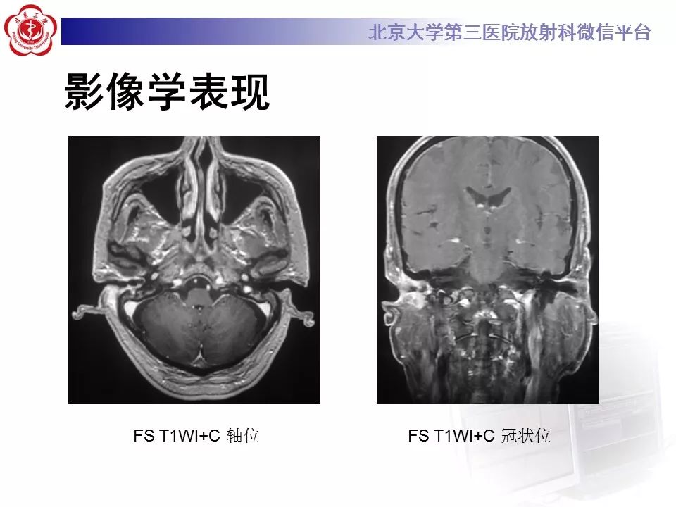 【病例】外耳道鳞癌1例CT及MR影像表现