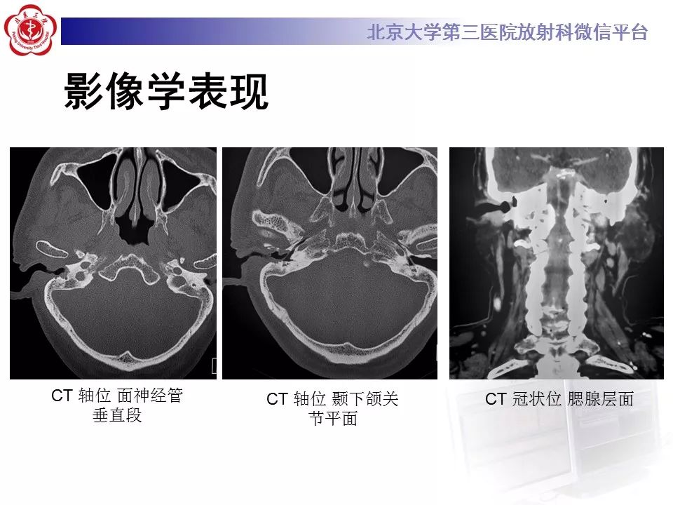 【病例】外耳道鳞癌1例CT及MR影像表现