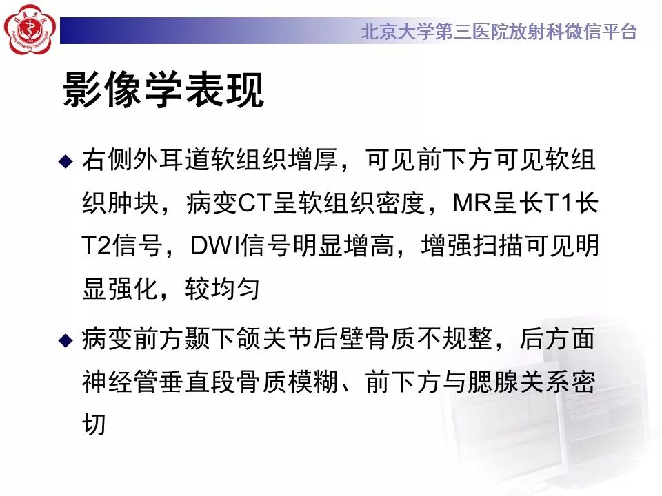 【病例】外耳道鳞癌1例CT及MR影像表现