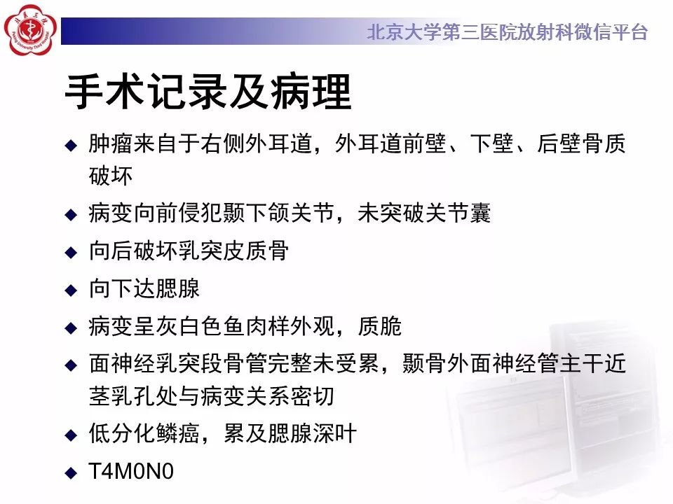 【病例】外耳道鳞癌1例CT及MR影像表现