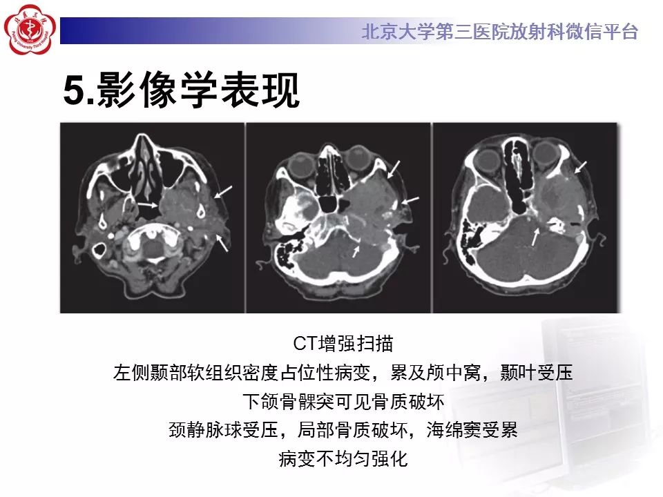 【病例】外耳道鳞癌1例CT及MR影像表现