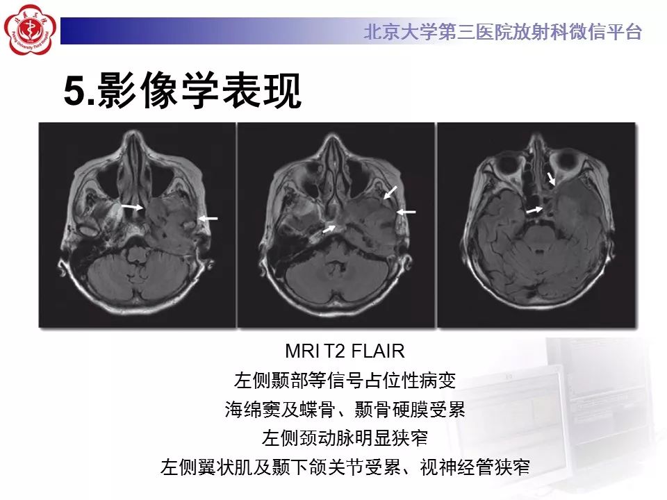 【病例】外耳道鳞癌1例CT及MR影像表现