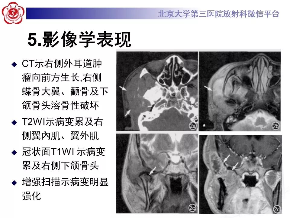 【病例】外耳道鳞癌1例CT及MR影像表现