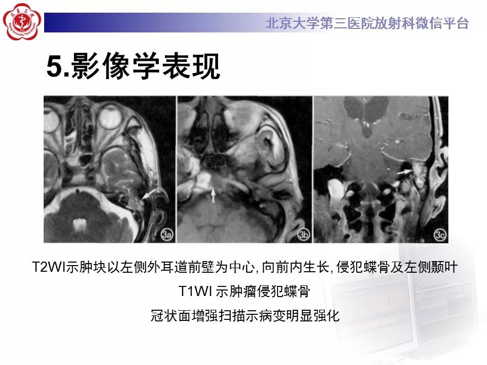 【病例】外耳道鳞癌1例CT及MR影像表现