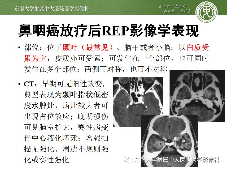【病例】放射性脑病1例CT及MR影像诊断