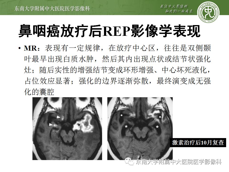 【病例】放射性脑病1例CT及MR影像诊断