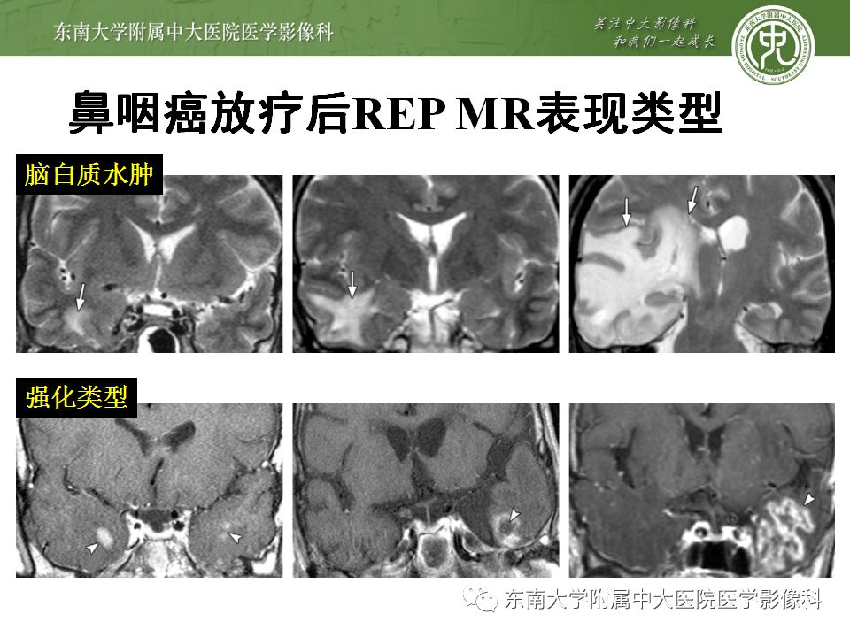 【病例】放射性脑病1例CT及MR影像诊断