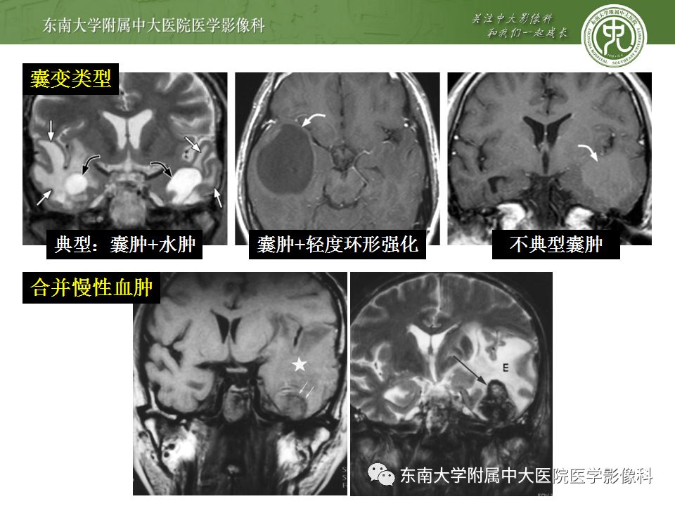 【病例】放射性脑病1例CT及MR影像诊断