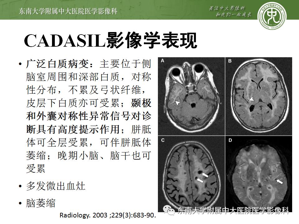 【病例】放射性脑病1例CT及MR影像诊断