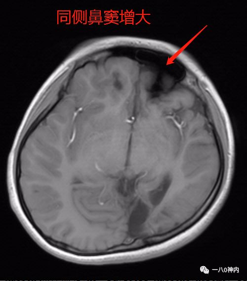 【病例】达-戴-马综合征1例CT及MR 【病例】达-戴-马综合征1例CT及MR
