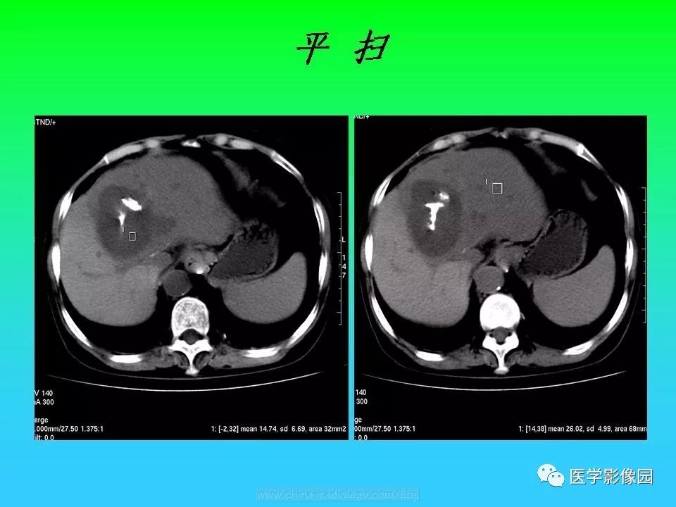 【病例】肝脏孤立性纤维瘤1例CT影像表现