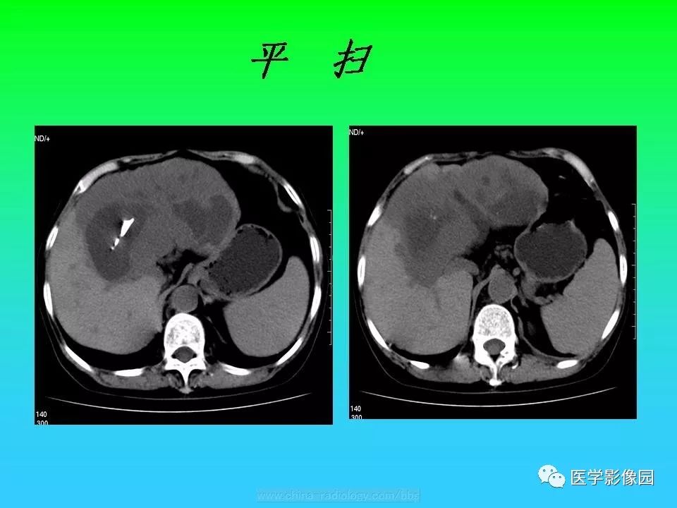 【病例】肝脏孤立性纤维瘤1例CT影像表现
