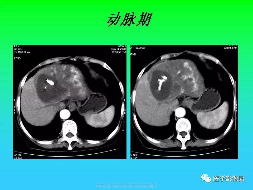 【病例】肝脏孤立性纤维瘤1例CT影像表现