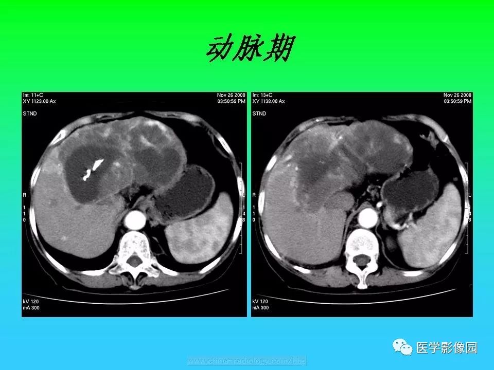 【病例】肝脏孤立性纤维瘤1例CT影像表现