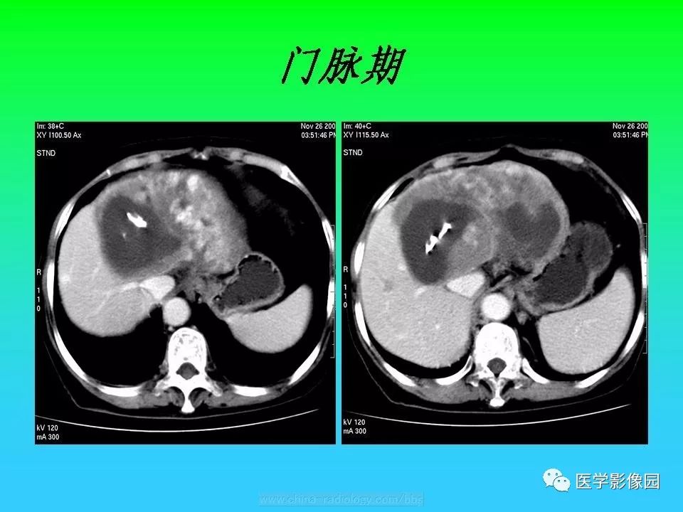 【病例】肝脏孤立性纤维瘤1例CT影像表现