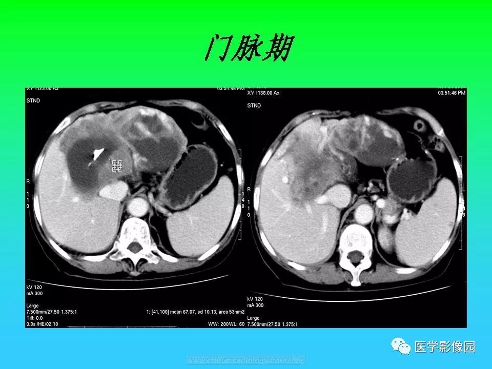 【病例】肝脏孤立性纤维瘤1例CT影像表现