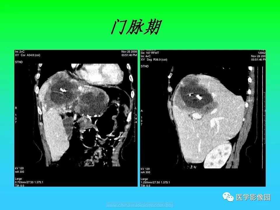 【病例】肝脏孤立性纤维瘤1例CT影像表现