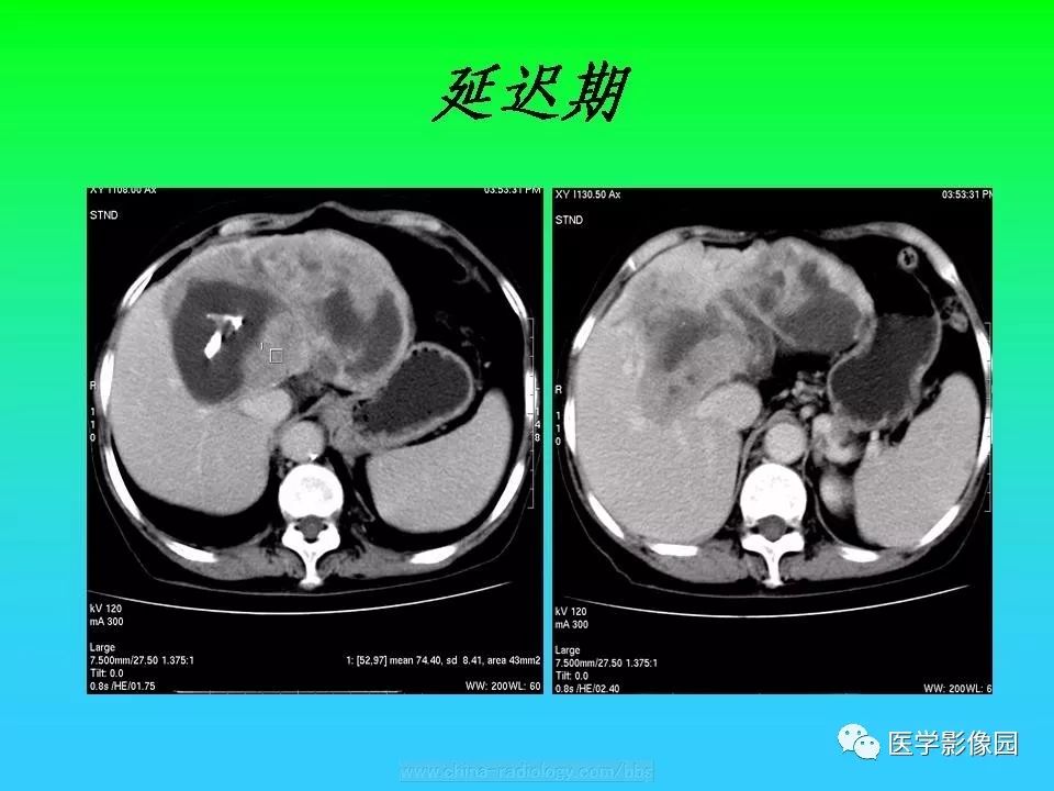 【病例】肝脏孤立性纤维瘤1例CT影像表现